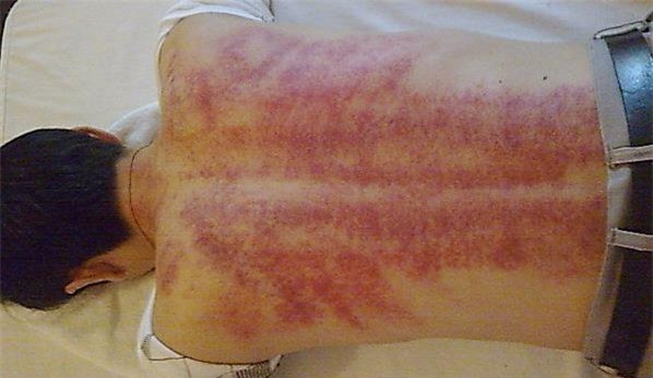 Giúp chồng cạo gió, chồng đột ngột hôn mê rồi qua đời. Cần chú ý những đối tượng không phù hợp cho việc cạo gió! - Ảnh 1.