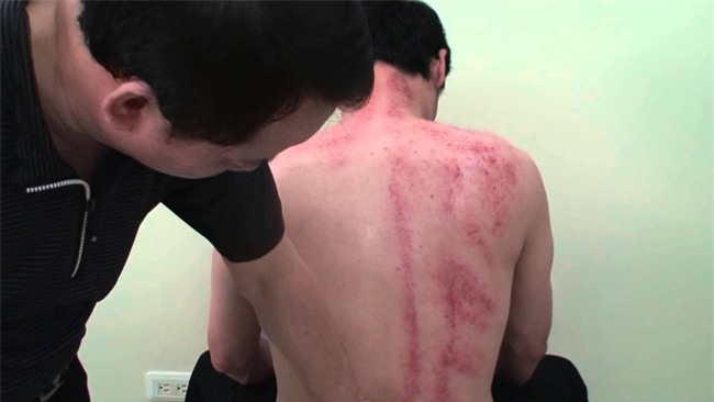 Giúp chồng cạo gió, chồng đột ngột hôn mê rồi qua đời. Cần chú ý những đối tượng không phù hợp cho việc cạo gió! - Ảnh 2.