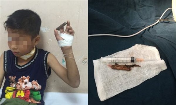 tai nạn hy hữu, xuyên cổ, dị vật, BV Nhi Trung ương