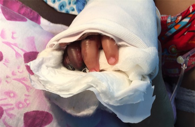 Bé trai bị thang cuốn ở sân bay Tân Sơn Nhất phải cắt một ngón tay - Ảnh 1.