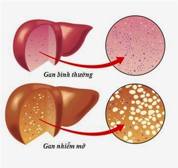 Trẻ nhỏ đã mắc gan nhiễm mỡ, dấu hiệu phát hiện sớm bệnh này - Ảnh 1.