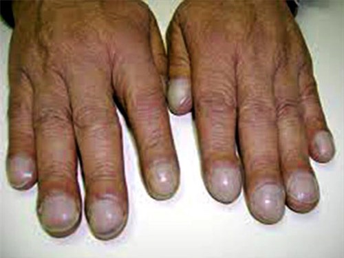 nhin mau sac mong tay, mong chan, doan benh 'chuan khong can chinh' - 3