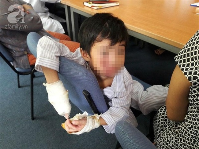 Bé trai bị điện giật chỉ còn 5 ngón tay lành lặn trong ngày xuất viện - Ảnh 1.