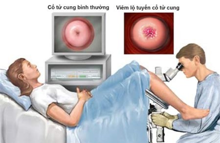 dot lo tuyen tu cung co anh huong den kha nang lam me? - 1