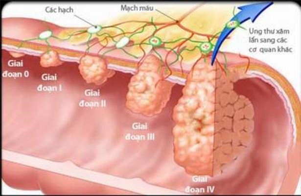 Chuyên gia Malaysia: 3 cách phát hiện sớm, loại bỏ ung thư đại trực tràng từ trứng nước - Ảnh 1.