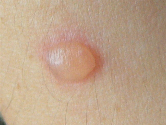 Giựt da móng tay, nhổ tóc bạc… đã đến lúc bạn phải ngưng ngay vì “sướng nhất thời nhưng hại cuộc đời” - Ảnh 6.