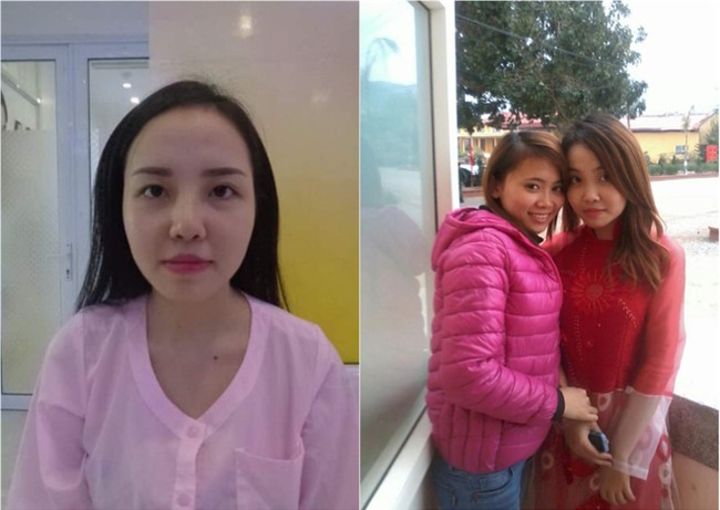 Bị bạn trai bỏ vì người thứ 3 xinh đẹp, cô gái Quảng Ninh chi tiền khủng đi thẩm mỹ - Ảnh 1.