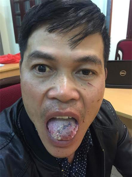 bi can gan dut luoi, 