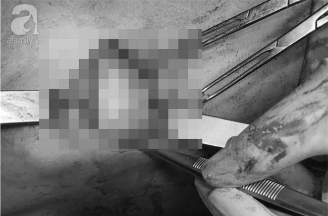 TP.HCM: Bơm silicon để ngực to như phụ nữ, nam thanh niên phải nhận cái kết đắng - Ảnh 3.