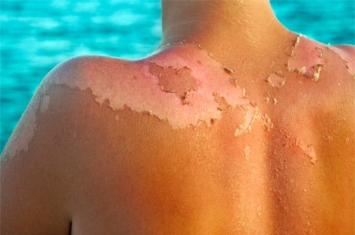 'Cuu nguy' cho lan da bi chay nang chi voi 5 meo nho nay