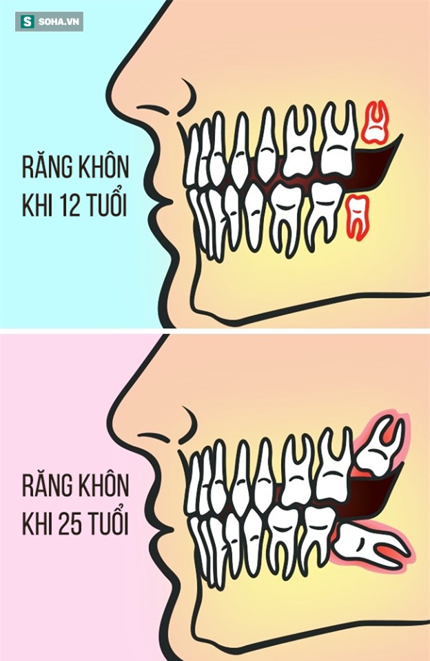 Răng khôn: Mỗi lần mọc lại một lần đau, khi nào nên nhổ? - Ảnh 1.