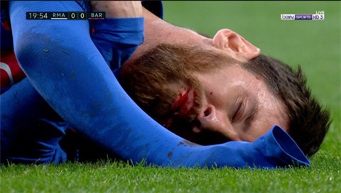 Trận thứ 2 liên tiếp Messi đổ máu trên sân