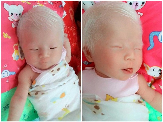 sinh con da trang nhu "trung ga boc", me dau long khi phat hien ra su that - 1