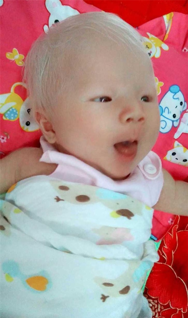 sinh con da trang nhu "trung ga boc", me dau long khi phat hien ra su that - 4