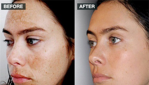 giá đỗ, củ cải trắng, mặt nạ giá đỗ và củ cải trắng, mặt nạ trị tàn nhang, giá đỗ và củ cải trắng trị tàn trang