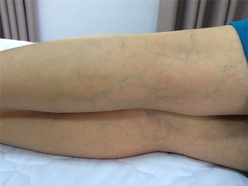Phụ nữ chớ nên coi thường việc nổi gân xanh trên cơ thể, nhất là trên chân - Ảnh 4.