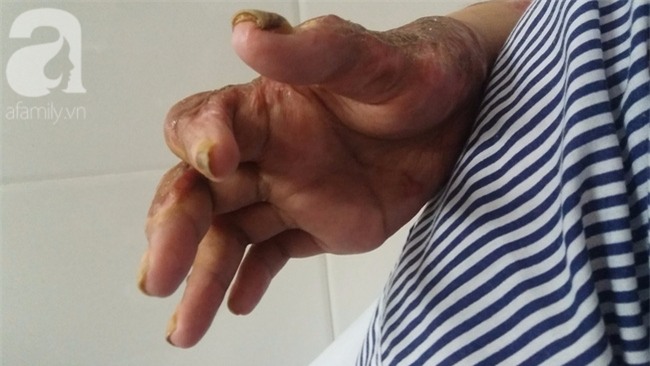 Nỗi đau và ký ức kinh hoàng của người vợ sống sót sau khi bị chồng nhốt rồi tẩm xăng cùng tự thiêu - Ảnh 2.