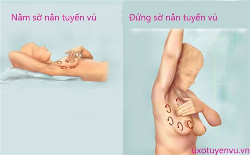 Cảnh báo của Giám đốc BV K trung ương: Khi có dấu hiệu sau, 80% là đã mắc ung thư vú - Ảnh 2.