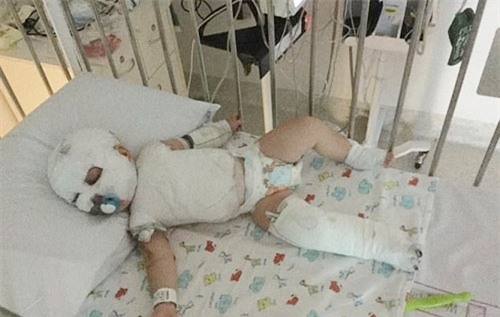 Đi du lịch, bị nước sôi đổ trúng người, bé trai 17 tháng không còn khả năng nói và đi lại - Ảnh 1.