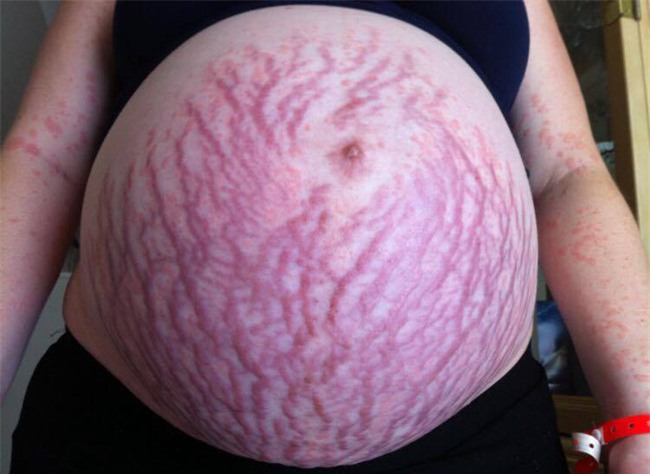 Hình ảnh hãi hùng của một mẹ bầu cảnh báo về căn bệnh phổ biến trong thai kỳ - Ảnh 1.
