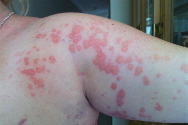 Hình ảnh hãi hùng của một mẹ bầu cảnh báo về căn bệnh phổ biến trong thai kỳ - Ảnh 5.