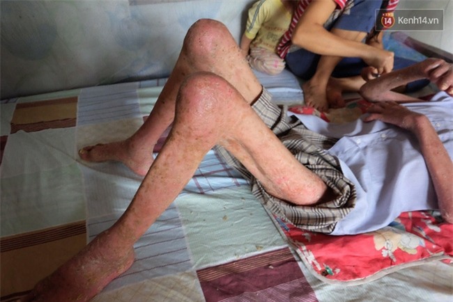 Cuộc sống khốn khó của người chồng liệt giường suốt 2 năm, từng muốn chết để vợ con bớt khổ - Ảnh 4.