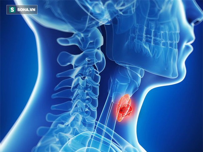 Ung thư vòm họng phát triển rất nhanh: Thấy có dấu hiệu sau thì khám ngay để ngăn ngừa - Ảnh 1.