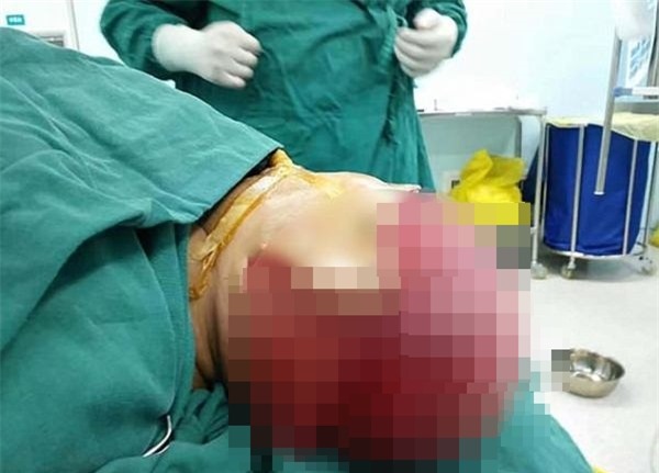 Để tóc xõa trong lúc làm việc, nữ công nhân bị máy sản xuất giật phăng cả mảng da đầu - Ảnh 1.