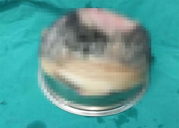 Để tóc xõa trong lúc làm việc, nữ công nhân bị máy sản xuất giật phăng cả mảng da đầu - Ảnh 2.