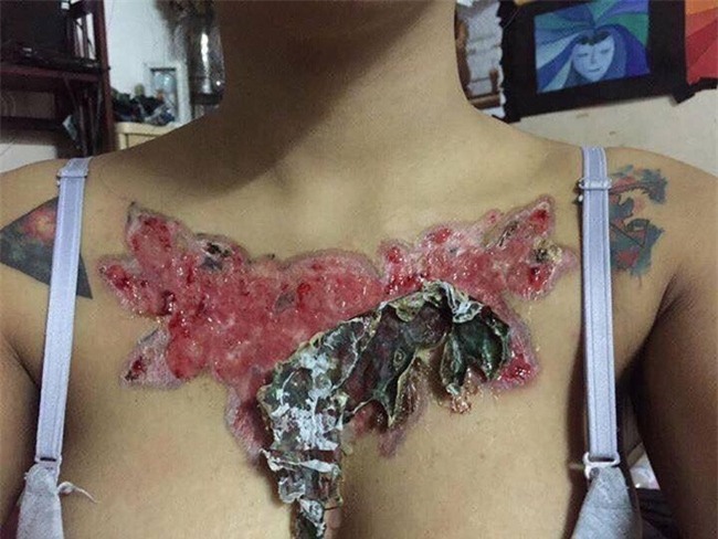 Sự thật câu chuyện cô gái xăm hình nhận hậu quả kinh hoàng sau khi người yêu bắt xóa xăm mới chịu cưới - Ảnh 6.