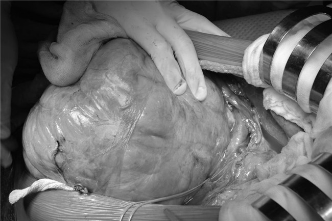 u thận, ghép thận, u bướu, suy thận, bệnh viện Đại học Y dược