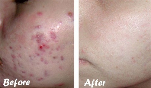 Bo ra 5 - 10 phut dung 1 nhum muoi, da trang min, sach khoe va het tham tuc thi