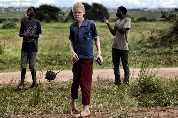 Noi so bi chat tay chan cua nguoi bach tang Malawi hinh anh 3