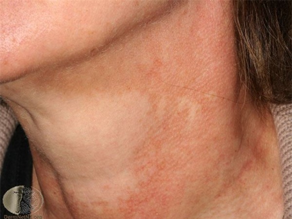 Qui tắc xịt nước hoa trong mùa nắng, cẩn thận để tránh rước bệnh về da - Ảnh 2.