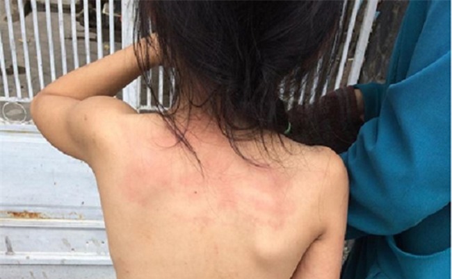 Sự thật bé gái lớp 3 bị bố mẹ lột trần, đánh đuổi ra khỏi nhà vì nhớ nhầm lịch thi