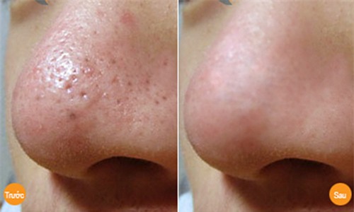 tri sach mun dau den cung dau chi voi 10 phut boi kem danh rang len mui - 5