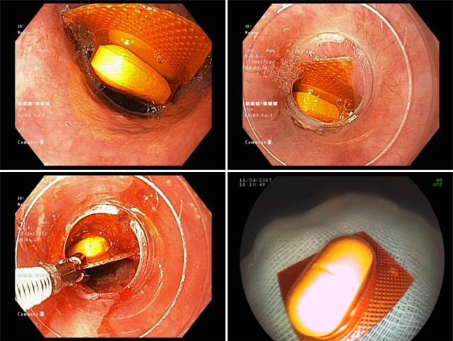 Bi hài những ca nội soi lấy dị vật ở người lớn - Ảnh 1.