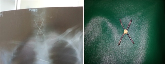 Bi hài những ca nội soi lấy dị vật ở người lớn - Ảnh 3.