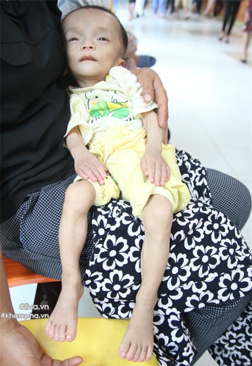 xot xa hinh anh em be sinh ra nang 4kg, sau mot nam chi con 3,4kg - 3