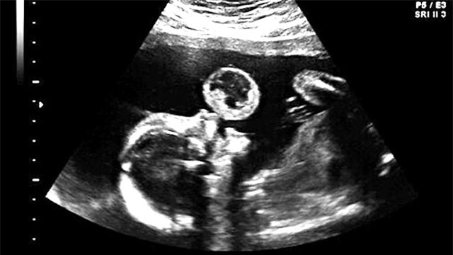 Siêu âm thấy con “thổi bong bóng” rất đáng yêu nhưng khi bác sĩ thông báo sự thật, người mẹ rụng rời tay chân - Ảnh 1.