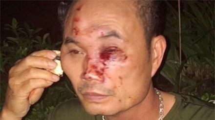 Anh Hảo bị côn đồ đánh rách mặt.
