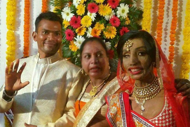 Co gai bi tat axit vao mat lay duoc chong nho goi nham so hinh anh 1