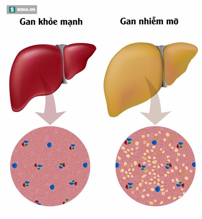 6 món trà dễ làm giải độc gan, tiêu mỡ gan hiệu quả - Ảnh 1.