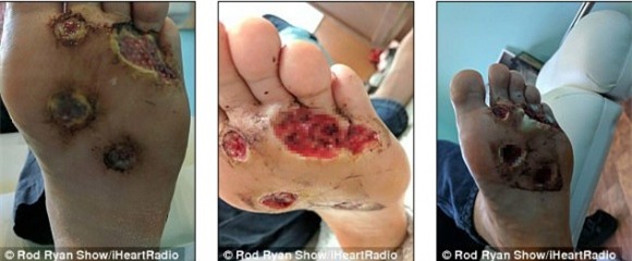 sức khỏe,chăm sóc sức khỏe,nhiễm virus,cảnh báo sức khỏe,vi khuẩn ăn thịt người,mụn cơm,tắm nơi công cộng,tắm ở nơi tập gym