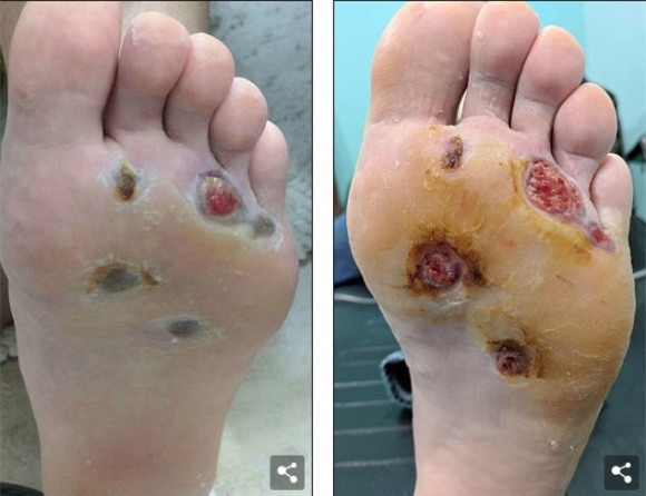 sức khỏe,chăm sóc sức khỏe,nhiễm virus,cảnh báo sức khỏe,vi khuẩn ăn thịt người,mụn cơm,tắm nơi công cộng,tắm ở nơi tập gym