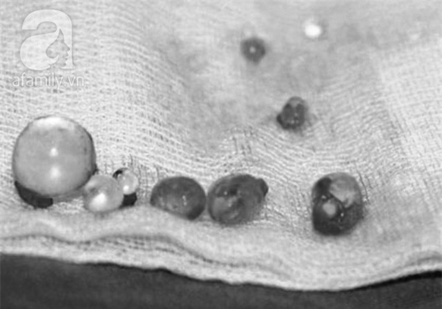 Bé trai 12 tuổi phải cắt bỏ một bên tinh hoàn vì căn bệnh vùng kín oái oăm - Ảnh 2.