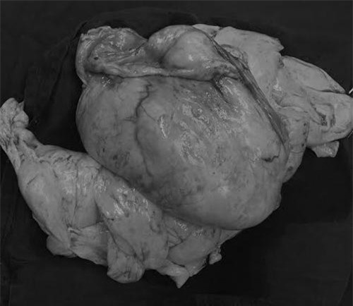 be trai 10 thang tuoi bi khoi u khong lo chen ep khien phoi bep nhu to giay - 2