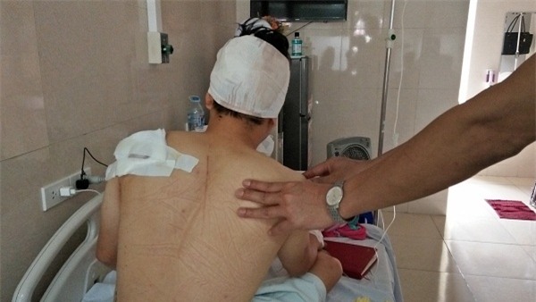 Anh T. hiện đang được điều trị tại bệnh viện