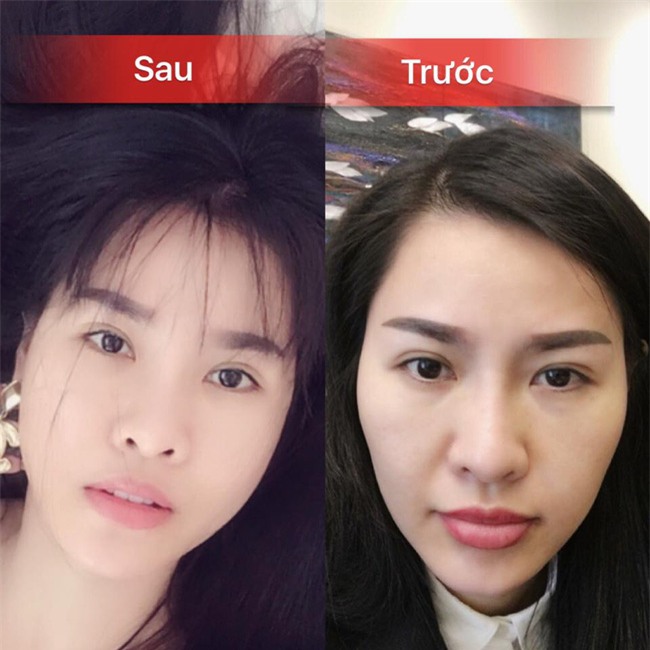 Sao Việt đang có xu hướng công khai quá trình phẫu thuật thẩm mỹ trên mạng xã hội - Ảnh 11.