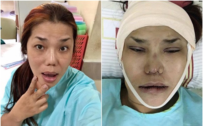 Sao Việt đang có xu hướng công khai quá trình phẫu thuật thẩm mỹ trên mạng xã hội - Ảnh 26.